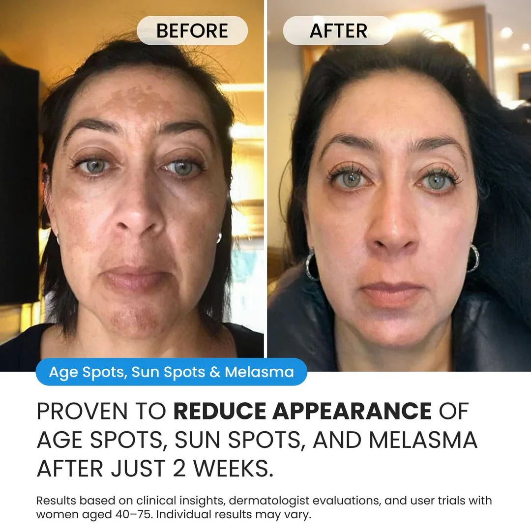 Dark Spot Corrector for Dark Spots, Melasma & Uneven Skin Tone - Image 5