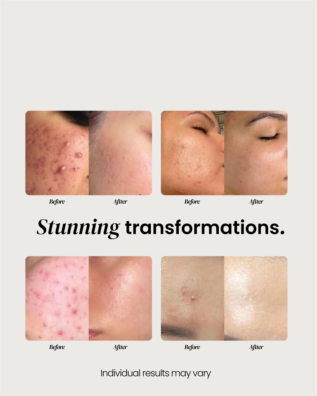 Hydrocolloid Pimple Patches - Image 7