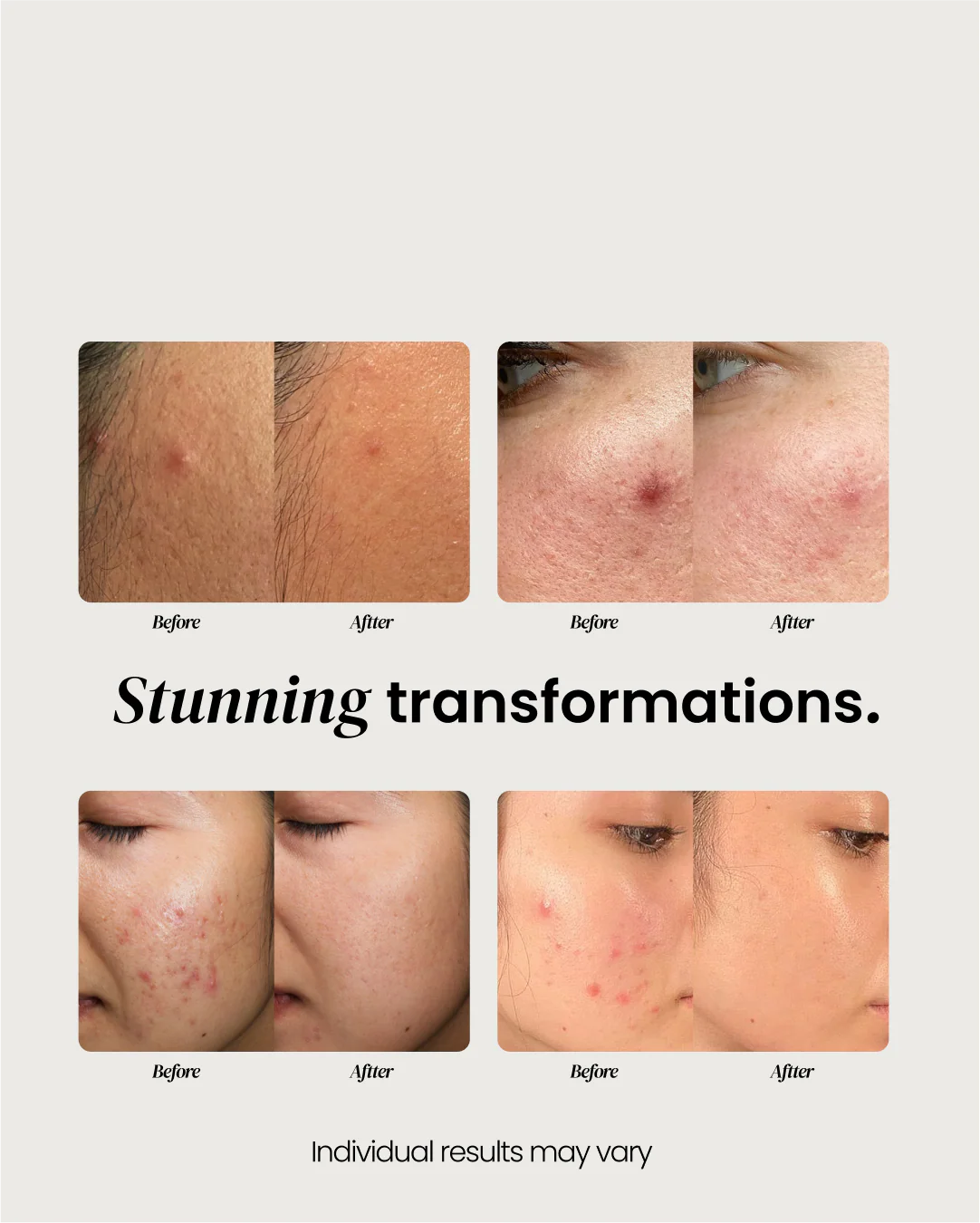 Overnight Pimple Patch - Image 7