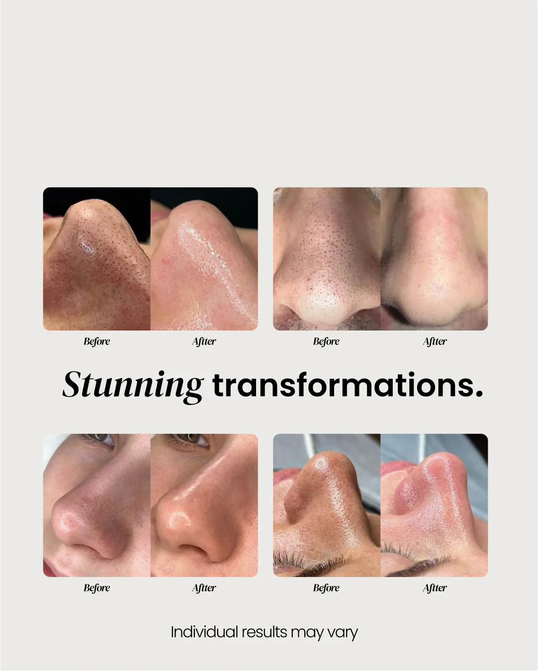 Nose Pimple Patch - Image 7
